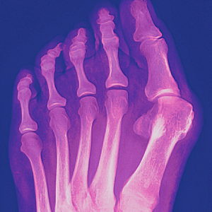 Bunion Hallux Valgus