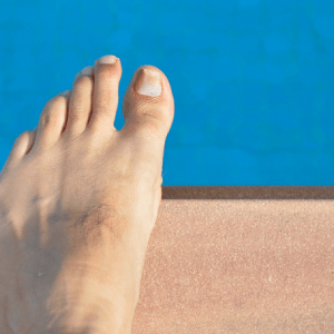 Ingrowing Toenail of the foot blog image 