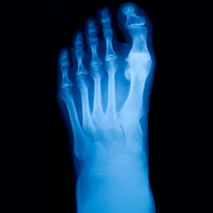 Hallux limitus xray showing arthritis on big toe joint