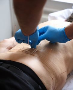 Dry Needling Therapy 