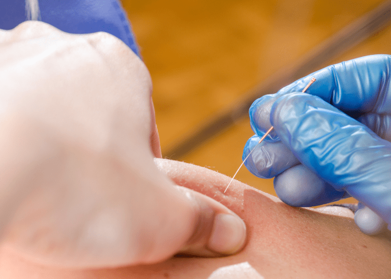 What is dry needling