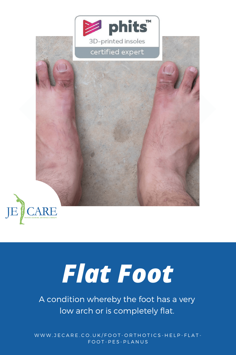 Flat foot orthotics Chelmsford JE Care blog