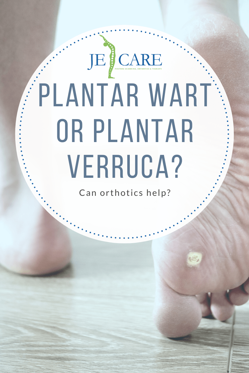 Plantar Wart or Plantar Verruca