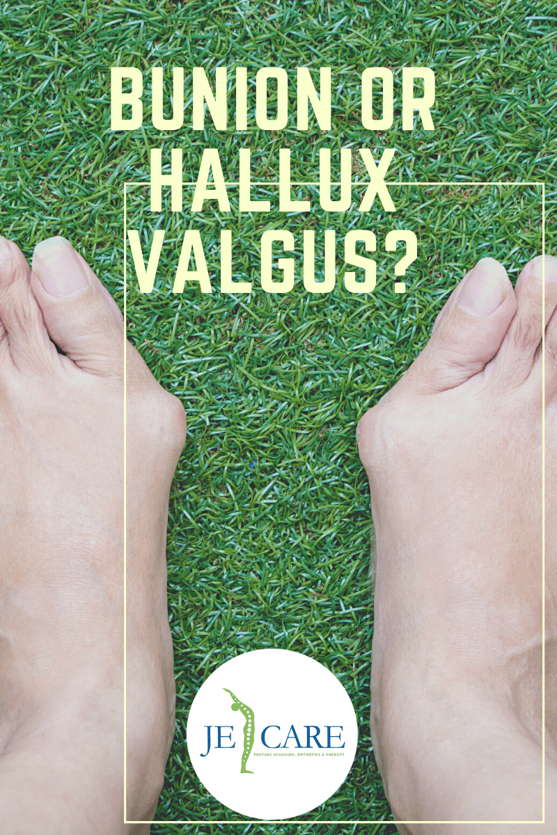 Bunion hallux valgus blog Chelmsford