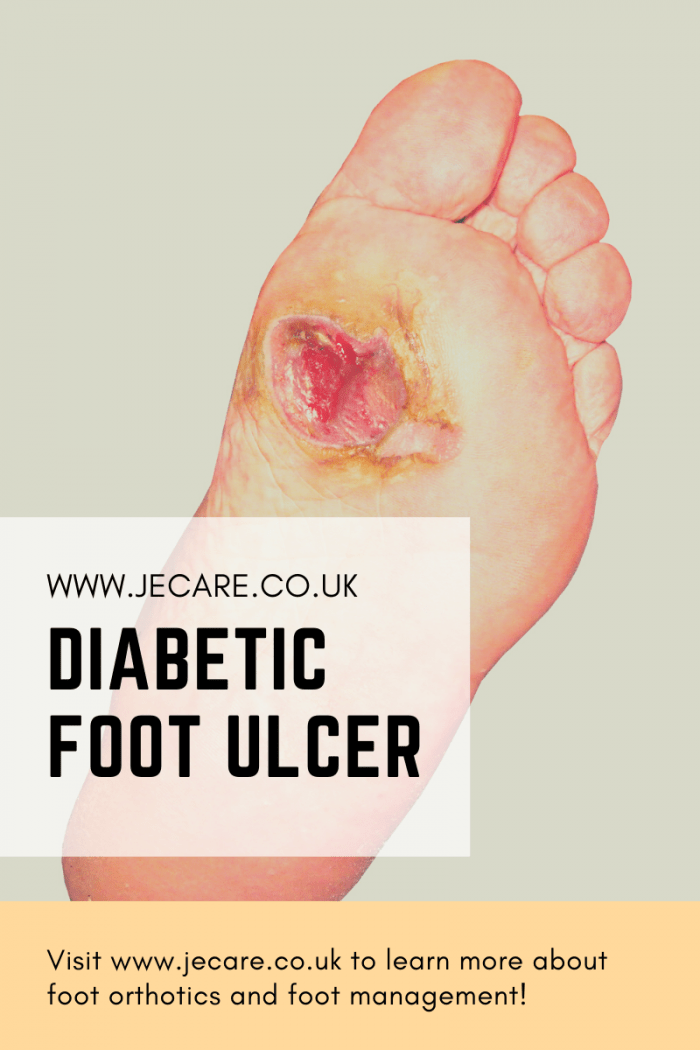 Diabetic Foot Ulcers Diagnosis Je Care Consultants Ltd