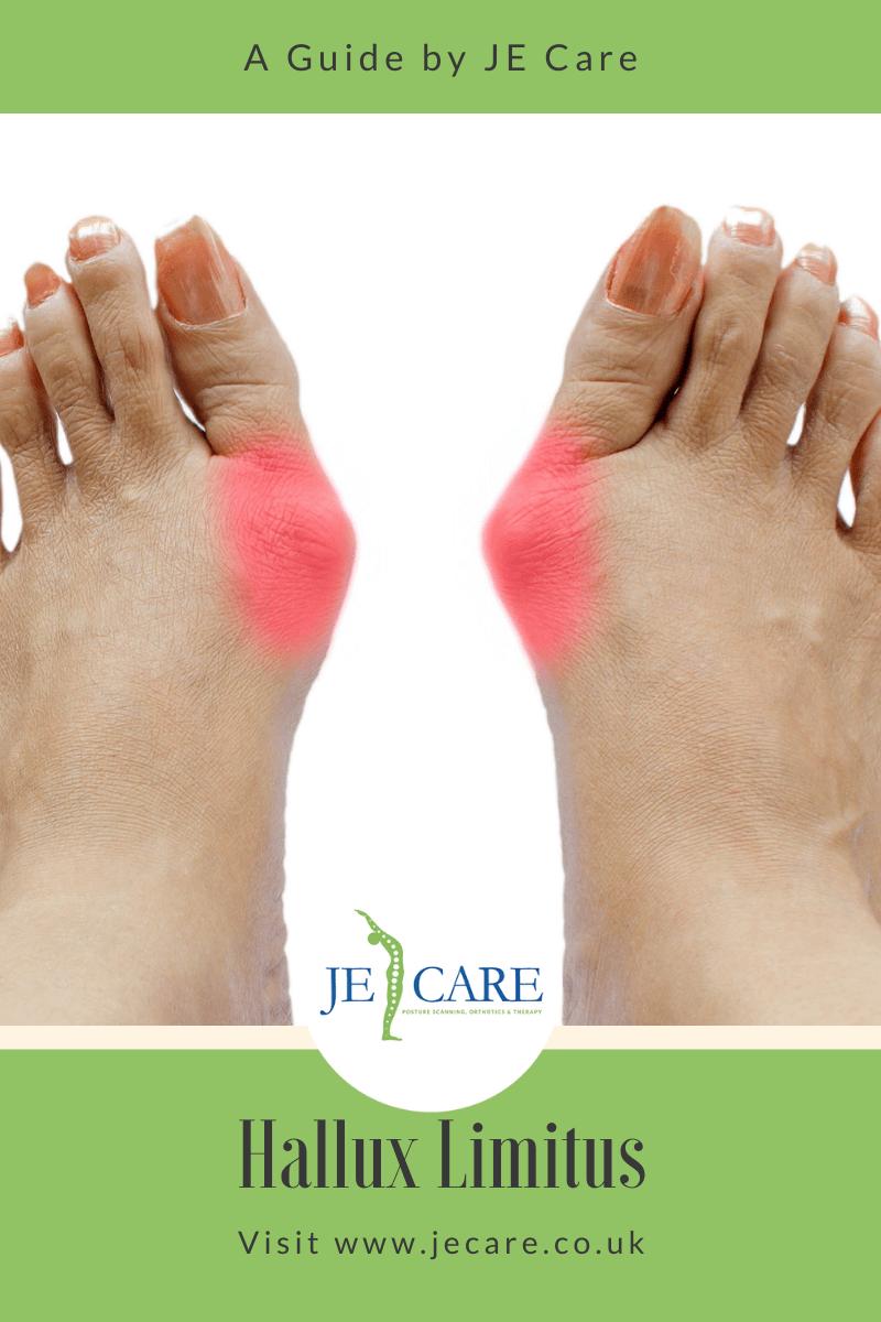 Hallux Limitus - JE Care & Consultants Ltd