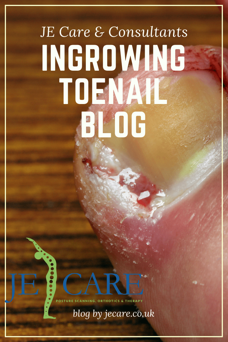 Ingrowing toenail blog cover JE Care