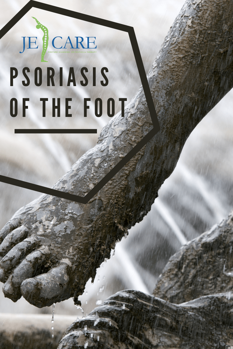 Psoriasis of the foot JE care blog image